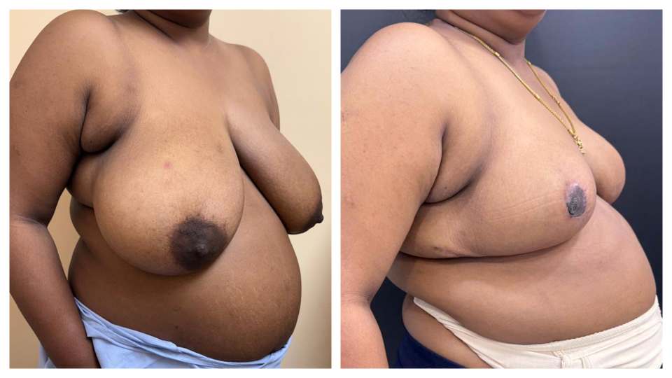 Patient Breast Implant KOQ10